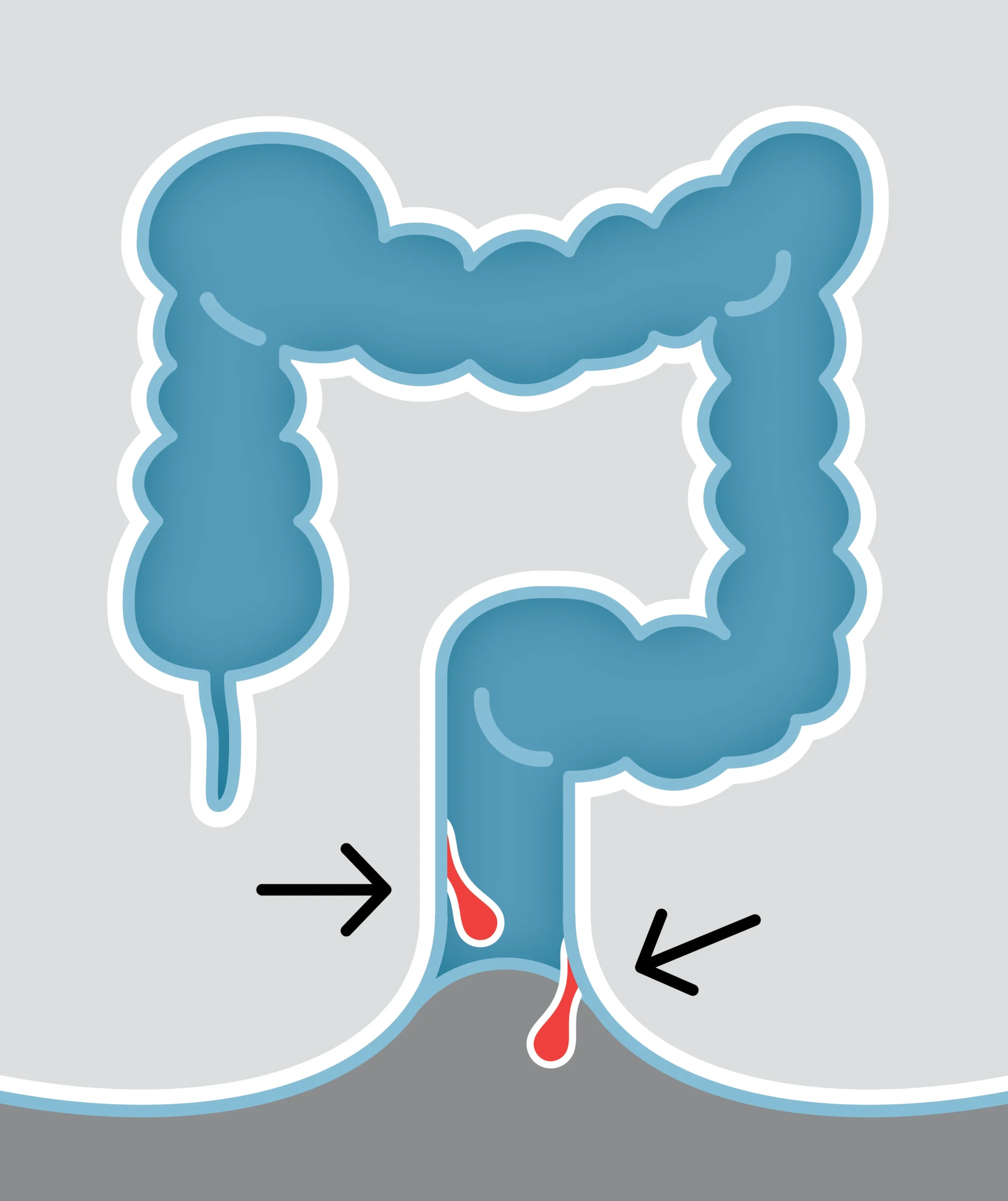 What Causes Hemorrhoids?