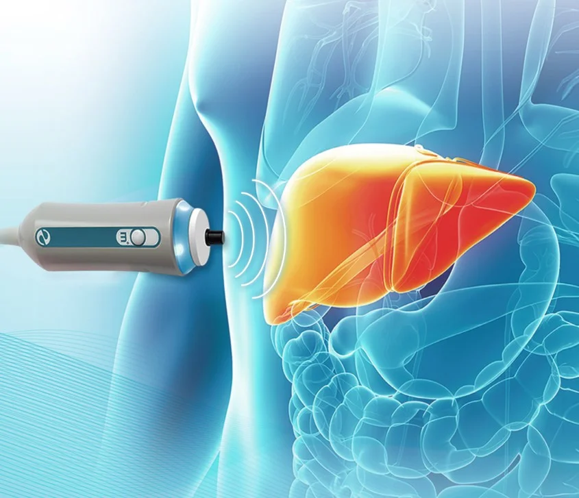 Introducing FibroScan - The Noninvasive Ultrasound Test For Liver Disease