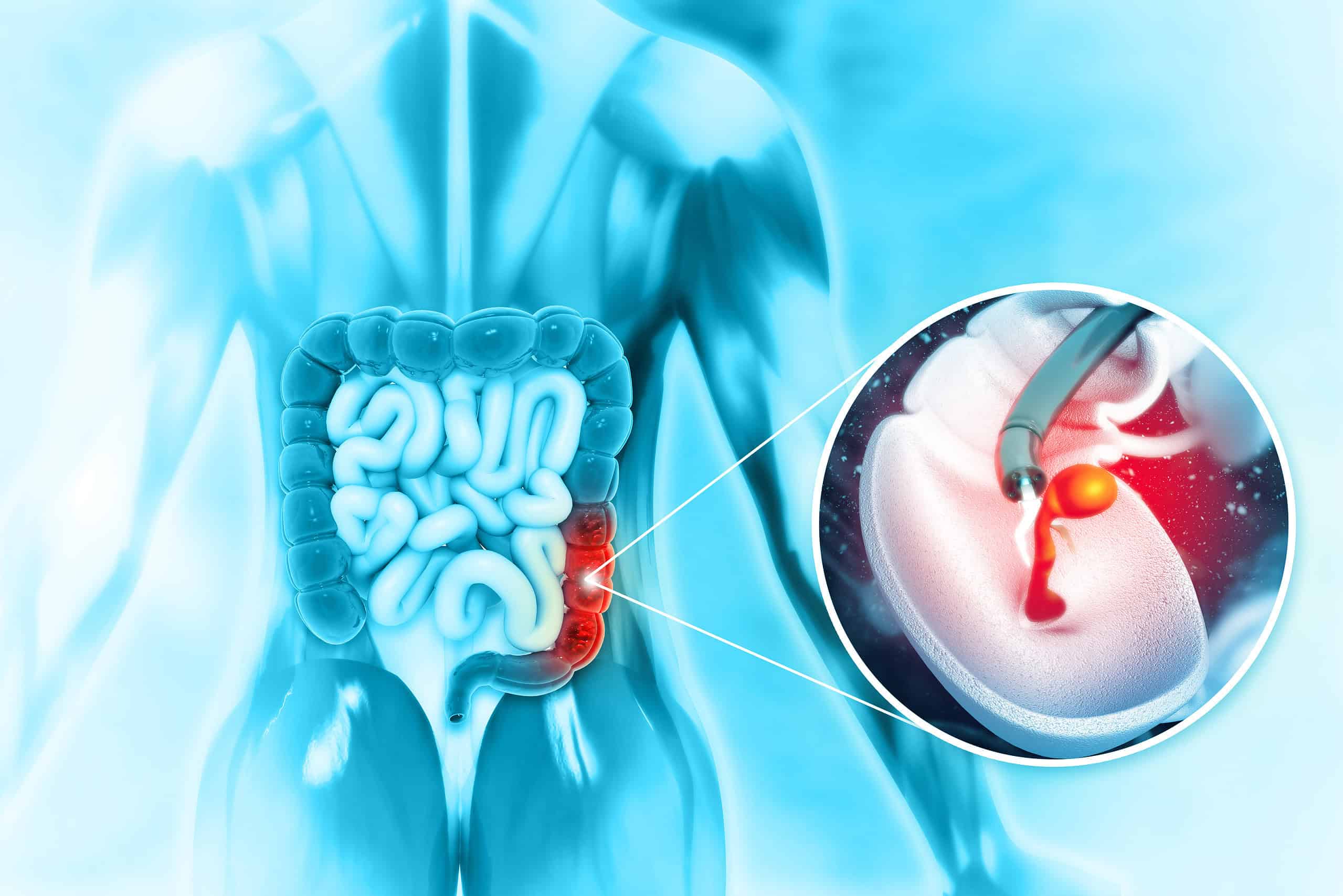 What is Colon Cancer?