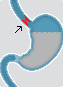 Barretts Esophagus