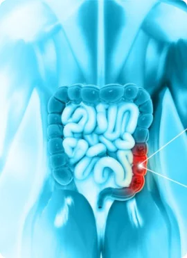 Colon-Cancer