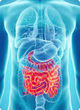 Crohn's Disease