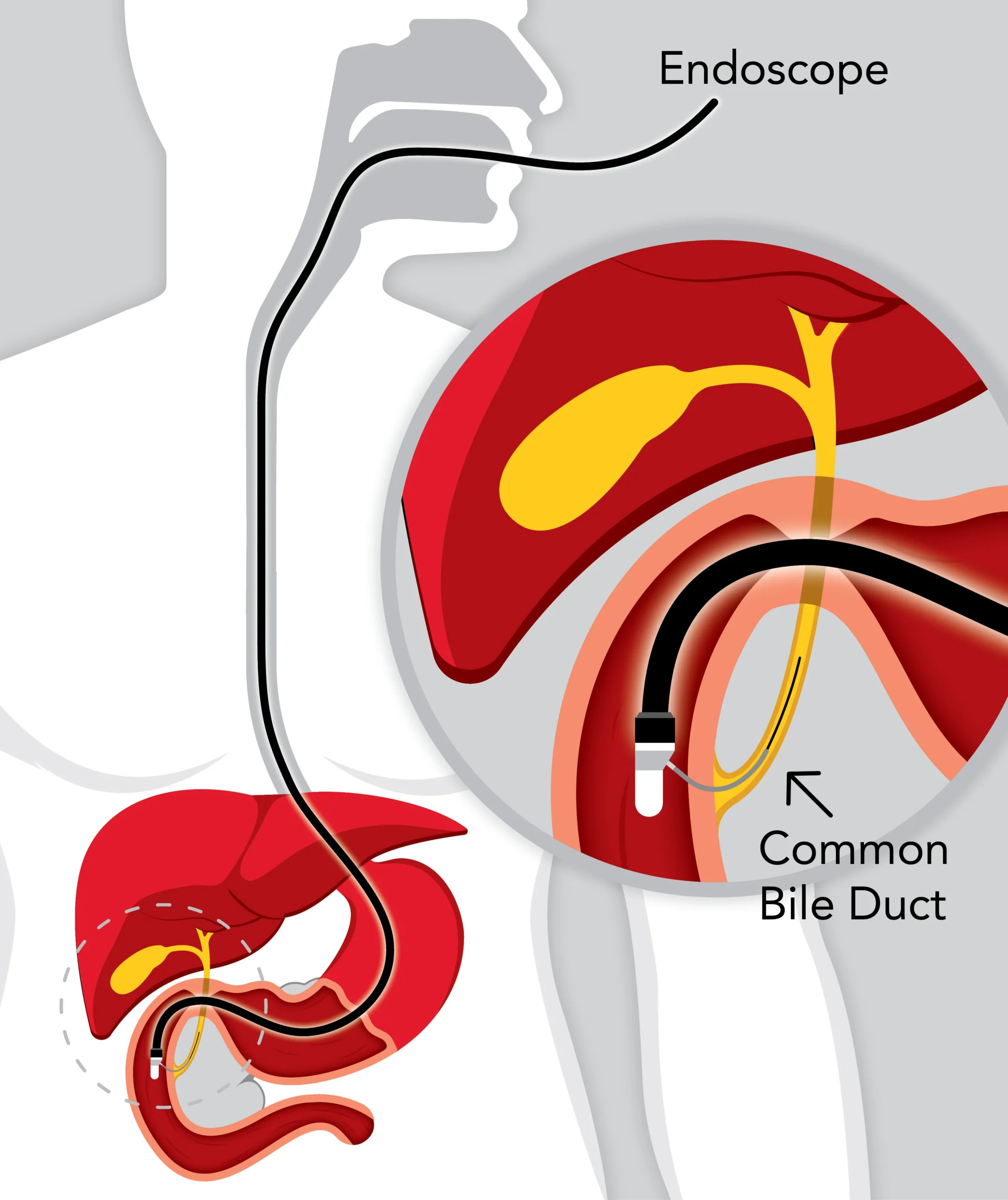 ERCP