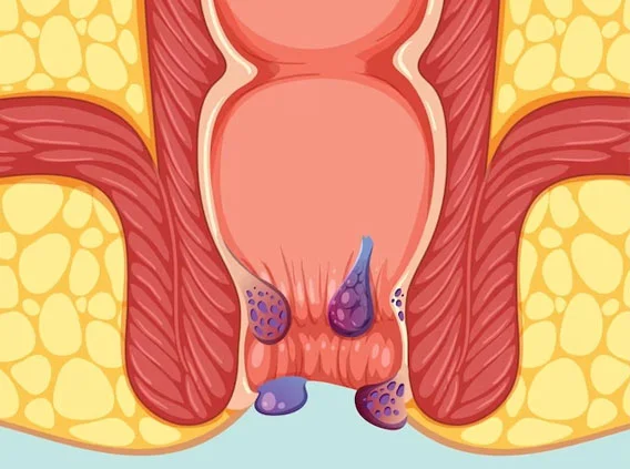 Hemorrhoids Treated