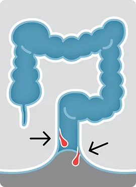 Hemorrhoids