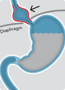 Hiatal Hernia