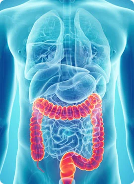 Ulcerative Colitis