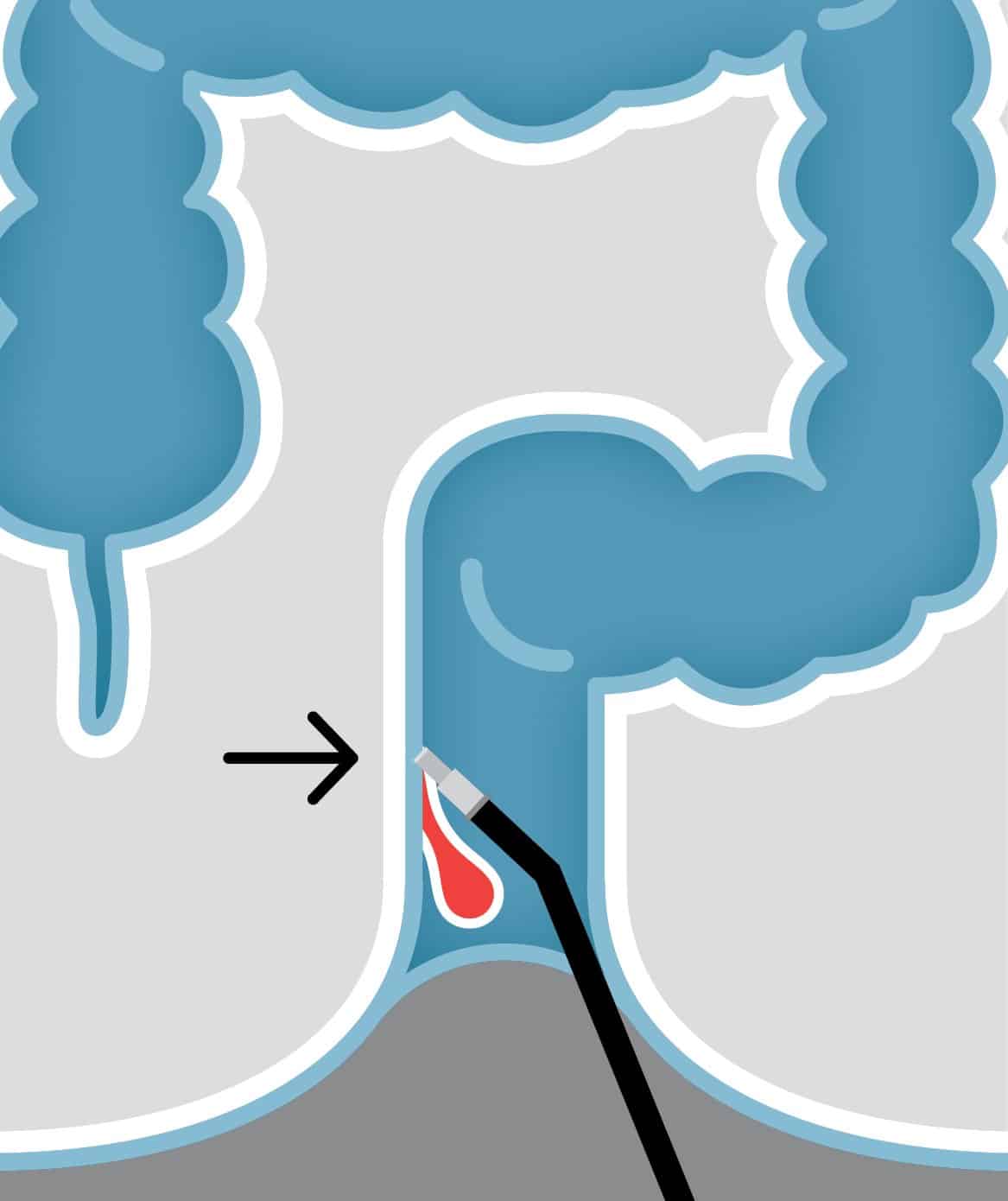 Infrared Coagulation (IRC)