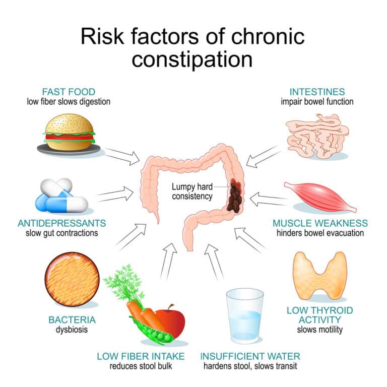 Illustration that shows common risk factors of chronic constipation. Gastrointestinal peristalsis and Chronic constipation. Bowel movement irregularities. Gut motility disorders.
